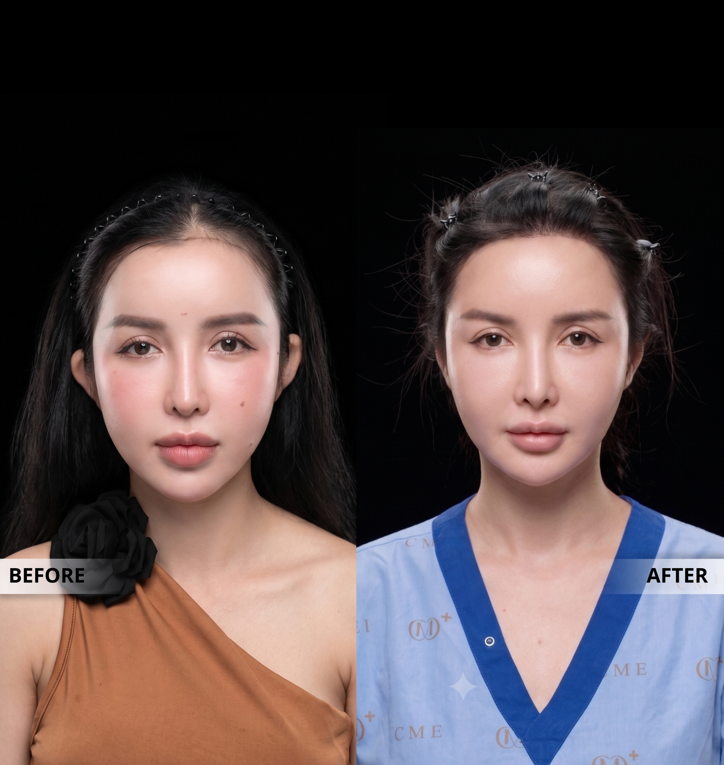 Cấy Tóc Thượng Hải